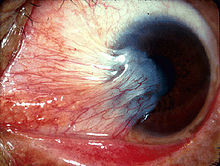 Pterygium